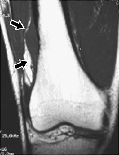 Physical examination of the right lower extremity revealed a subtle fullness in the lateral part of the distal shaft of femur with full range of motion of the right knee.