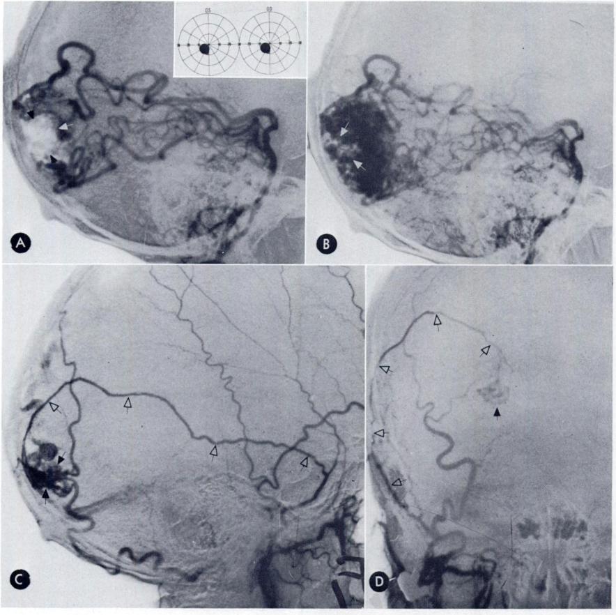 542 B. Todd Troost and Thomas H. Newton NOVEMBER, 1974. (A and B) Vertebral arteriograms, lateral projection.