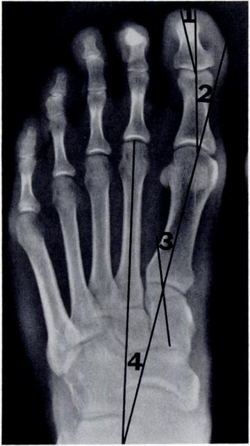 120 KARASICK AND WAPNER AJR:155, July 1990 Fig. 1.-Normal (N) angles in anteroposterior erect foot as measured on radiographs.