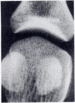 B, Equal metatarsal lengths: honzontal line intersects first metatarsal head within 2 mm.