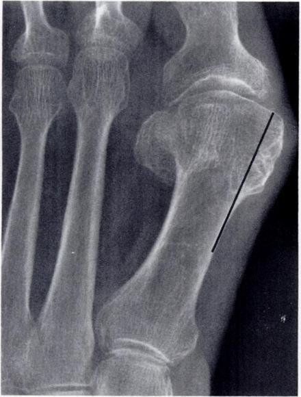 unless an osteotomy of first metatarsal is performed. Fig. 8.