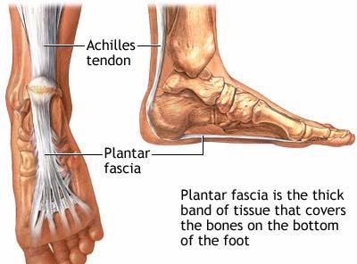 Plantar Fasciitis Plantar fasciitis = Irritation of the plantar fascia, mostly the medial slip Irritation is caused by an over-stressing