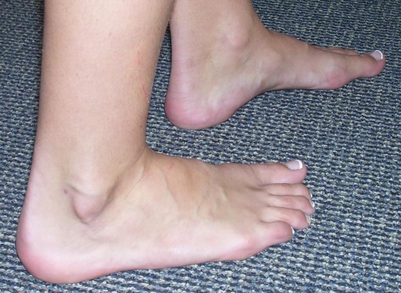 foot types a normal or