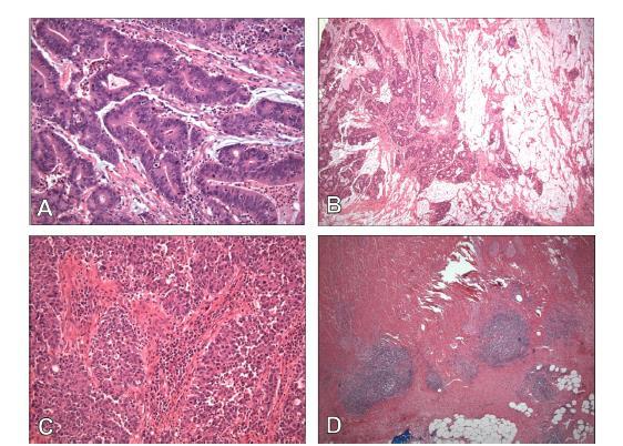 Phenotype of d-mmr/ MSI Infiltrating Mucinous differentiation Poorly differentiated with medullary growth pattern