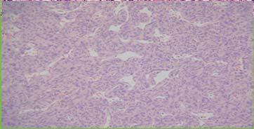 Spindle cell proliferations - Peritoneum Neoplasms & Tumor-like Lesions Malignant peritoneal