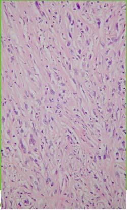 Peritoneum Tumor-like Lesions Mesenchymal Tumors Solitary Fibrous Tumor Omental Mesenteric