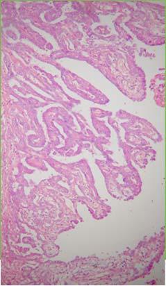 fibrous periorchitis Inflammatory pseudotumor NEOPLASTIC Malignant mesothelioma Mesenchymal -