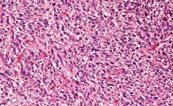 MODERN PATHOLOGY 2010 23 470-479 Tumor histology (%) Conventional sarcomatoid MM of NOS subtype 44% Sarcomatoid with desmoplastic areas 21% Desmoplastic 34% Osteosarcomatous and/or chondrosarcomatous