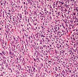 Is the spindle cell proliferation