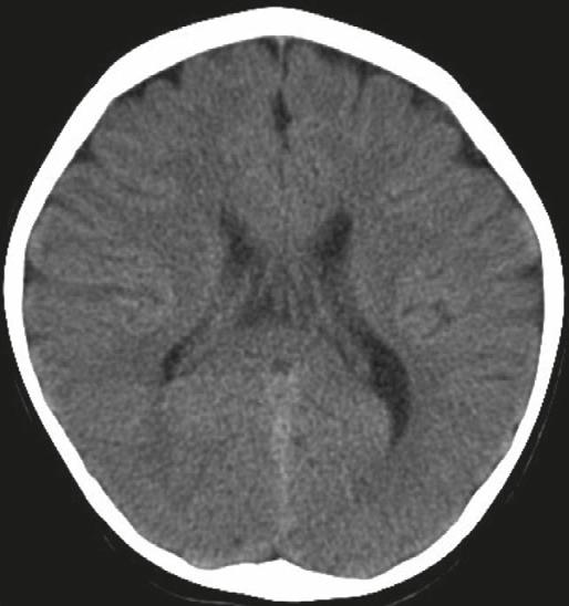 New-onset seizure in pediatric emergency 107 A B C D Figure 1 Brain imaging studies showing a 1 year and 8-month-old girl (patient no.