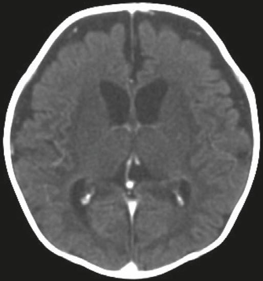 9 in Table 3) who presented with cyanosis and seizure after choking on milk, showed low attenuation over bilateral basal ganglia, thalami and periventricular white matter zone on CT (white arrow).