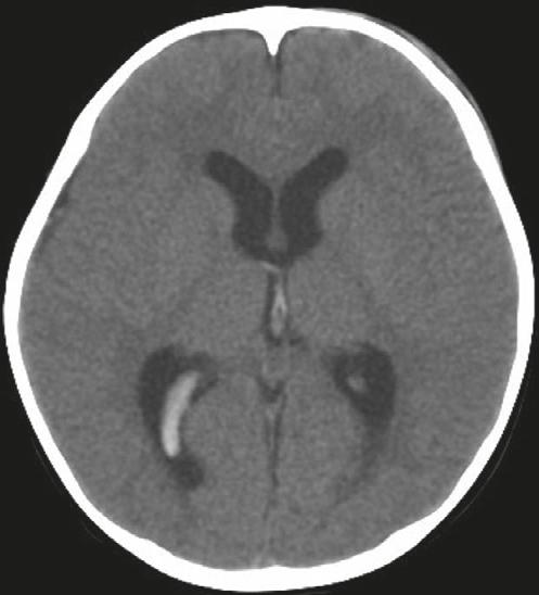 1 in Table 3) suffered a head injury in a traffic accident and brain CT showed intraventricular hemorrhage (white arrow) and mild subarachnoid hemorrhage.