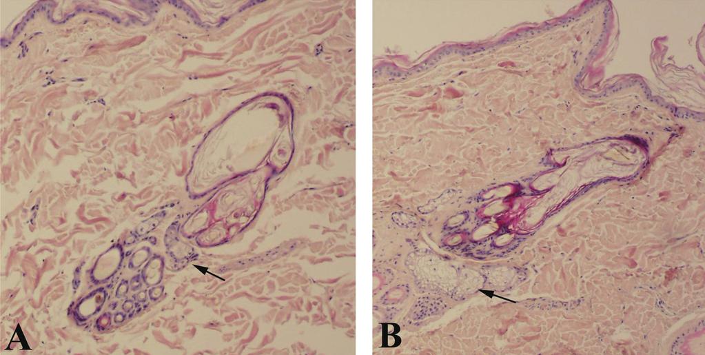 Fickle, D.C., et al. Fig. 1. 99 Normal skin. A = Note the size of sebaceous glands (arrow) and location relative to hair follicle. H&E stain 200.