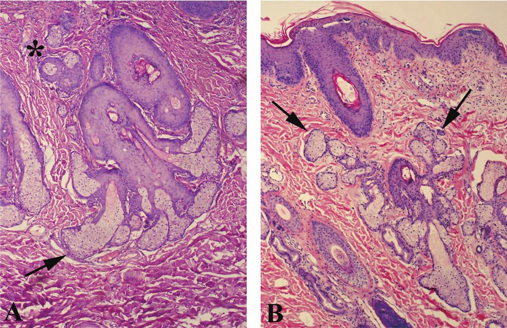 A = Sebaceous glands are hyperplastic and directed laterally (arrow) and dorsally (asterisk). H&E stain 200. B = Sebaceous glands are hyperplastic and directed dorsally (arrows). H&E stain 200. stained sample available (least sampling and processing artifact).