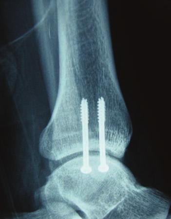 58 CHAPTER 12 Figure 1C. Fixation of the pronation-abduction stage I injury. Figure 2A. Demonstrates what appears to be a normal radiograph in a patient sustaining an ankle injury.