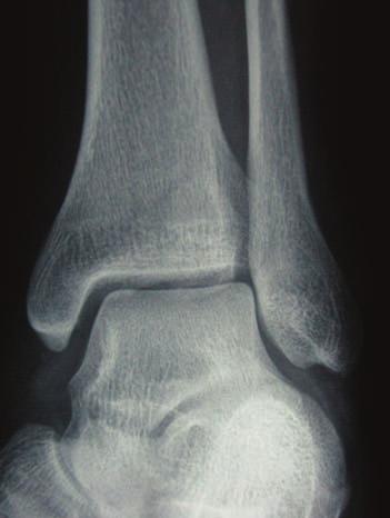 Stage II represents a rupture of the syndesmotic ligaments. The talus slides laterally pushing the fibula away from the tibia.
