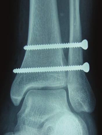 CHAPTER 12 59 Figure 2D. Shows ankle mortise anatomically reduced and fixated with two 4.5 mm cortical screws. on the lateral radiograph.