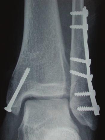 The fibular fracture is anatomically reduced and fixated with a laterally applied plate.