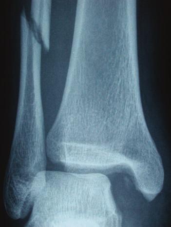 60 CHAPTER 12 A variation of the pronation-abduction mechanism can produce a fracture above the syndesmosis. This usually occurs in the distal one-third of the fibula (Figure 4).