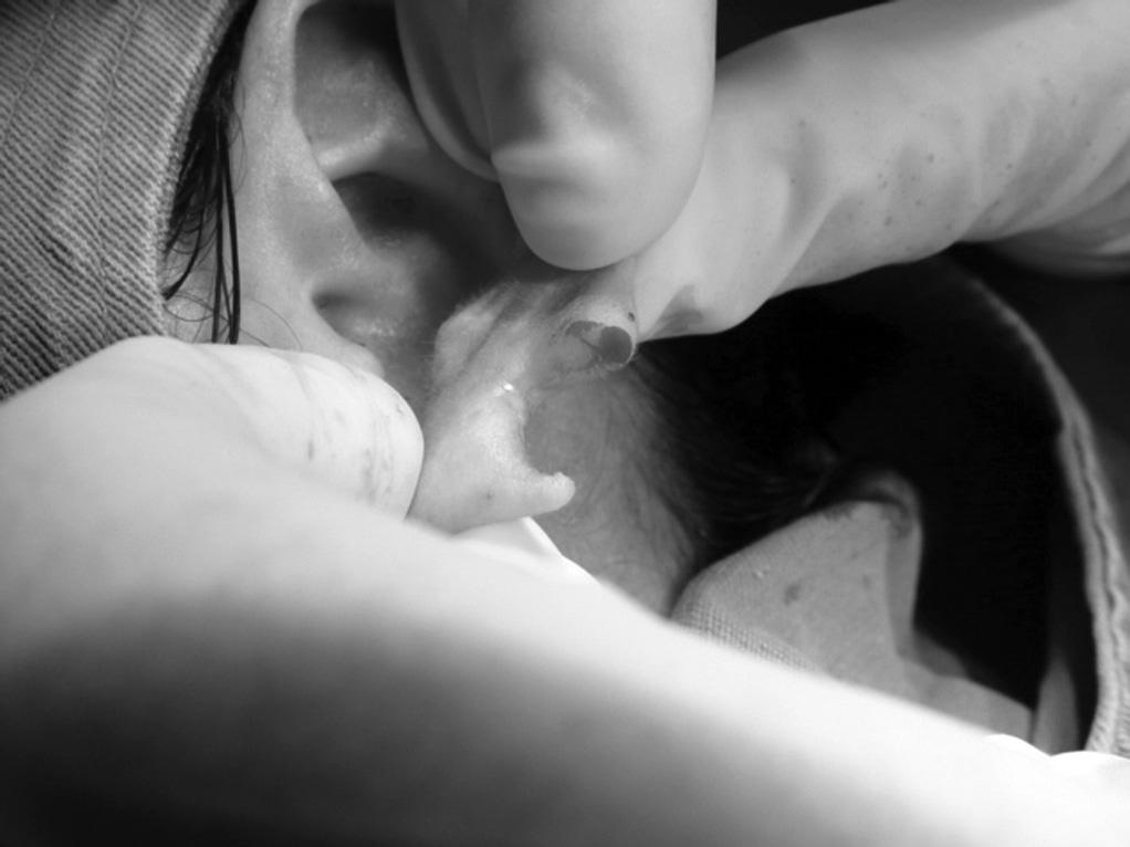 completing the earlobe cleft towards the lower