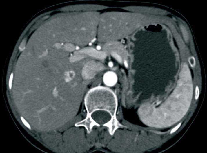 The most frequent unexpected finding after examination and the object of further diagnosis verification is liver hemangioma.