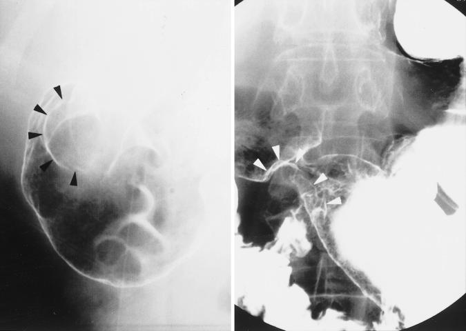 S. Mrushi et l.: Primry squmous cell crcinom of the stomch 137 Fig. 1. Left: Gstric swllow efore low-dose FP chemotherpy shows n elevted lesion round pylorus ring (rrowheds).