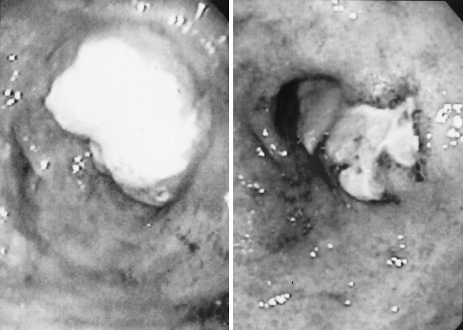 Left: Endoscopic exmintion efore chemotherpy shows type 1 lesion whose top is ulcerted nd covered with fur.