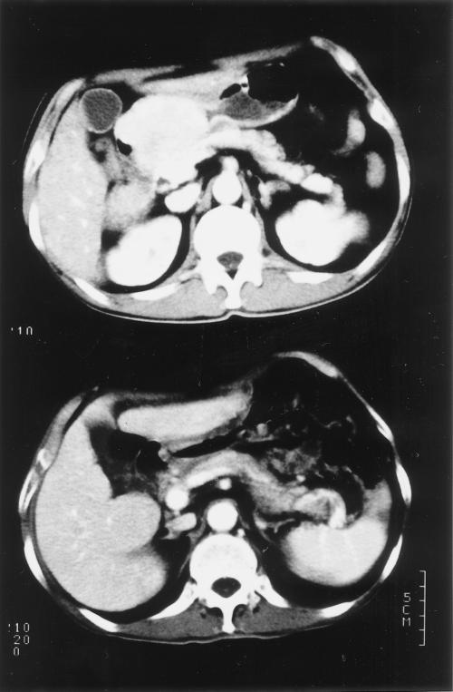 138 S. Mrushi et l.: Primry squmous cell crcinom of the stomch Fig. 4. Angiogrphy shows hypervsculr tumor (rrowheds) in the ntrum of the stomch or pncres hed.