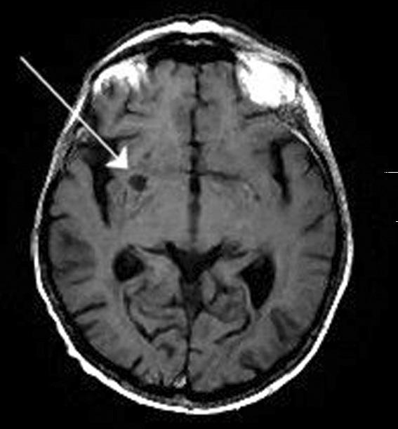 General introduction Cerebral white matter lesions and asymptomatic brain infarcts are common in elderly people.