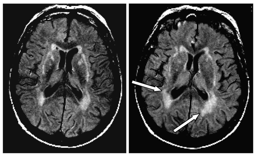 Measuring progression of cerebral WML on MRI to visualize the relation between the change in WML assessed with the volumetric method (in ml), and the visual rating scales.