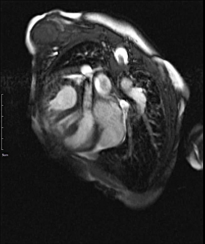 (e) Patient with atrioventricular septal defects, a frame from short axis cine showing the coarse trabeculations in the right