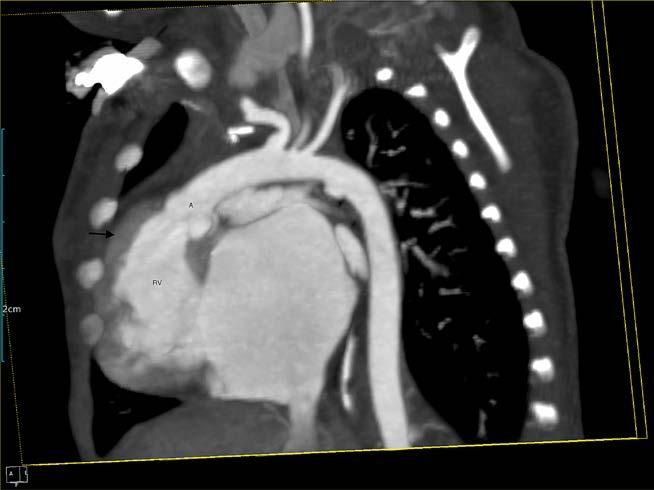 (a) Baby with atrioventricular septal defects, CT with coronal reformat and lung window setting showing the branching of left and right main bronchi into upper lobe bronchus and bronchus