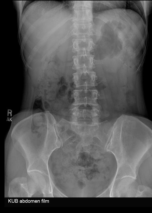 Radiography (plain old x-ray) Good at: Screening for pneumoperitoneum Screening for bowel obstruction or ileus Evaluating tube
