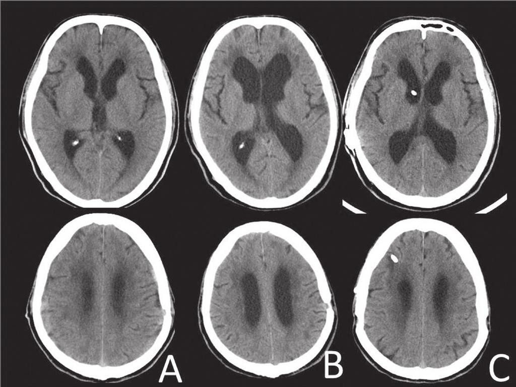 Fig. 6 A: Computed tomography (CT) scans taken soon after the burr-hole drainage show disappearance of the hematoma.