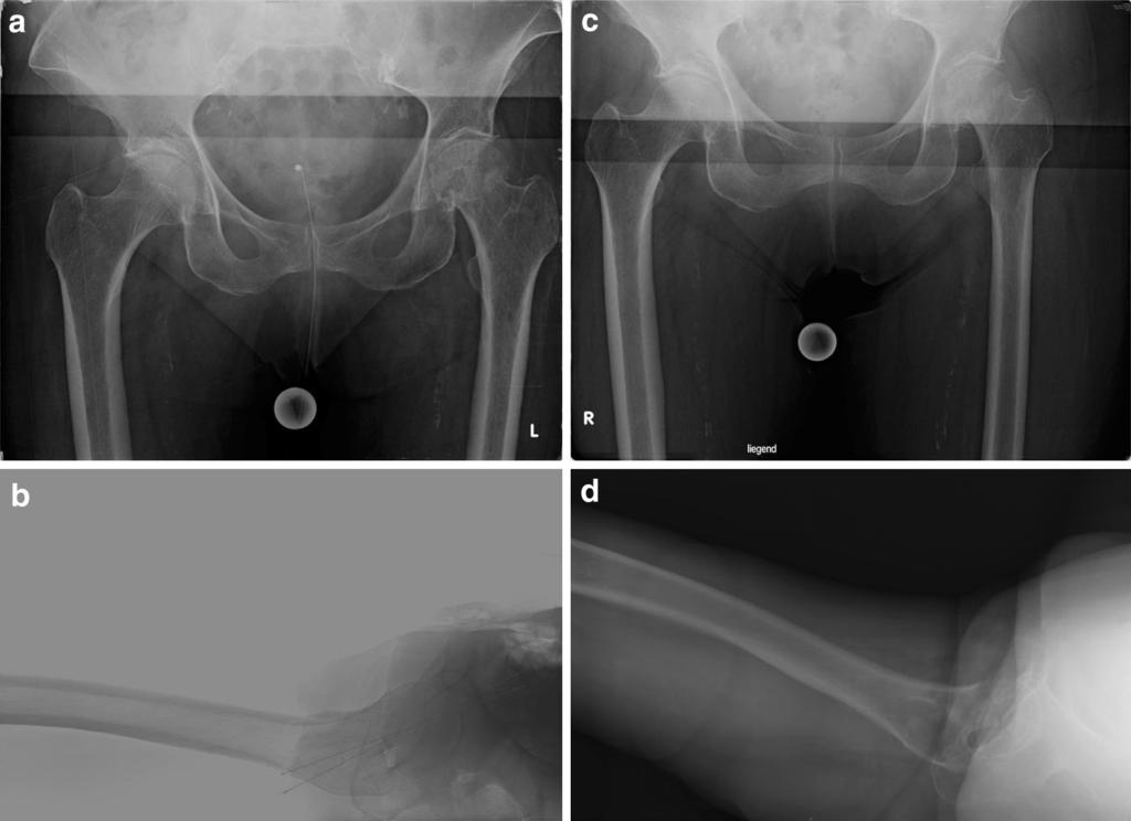 246 Arch Orthop Trauma Surg (2015) 135:243 249 Fig. 1 Primary non-operative treatment of a 75 years old female patient, initial AP (a) and axial (b) X-ray after trauma, classified as Garden I.