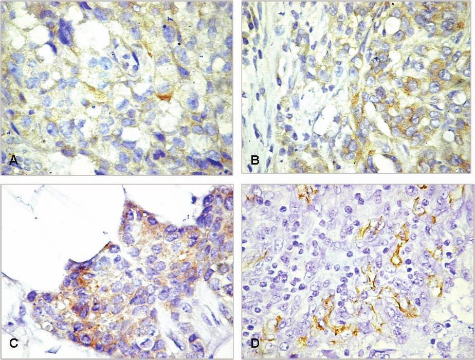 414 ŞERBAN COMŞA ET AL. Fig. 1. Immunohistochemical expression of VEGF and CD31 in breast cancer specimens. A. VEGF expression 1+; B. VEGF expression 2+; C. VEGF expression 3+; D. CD31 expression.