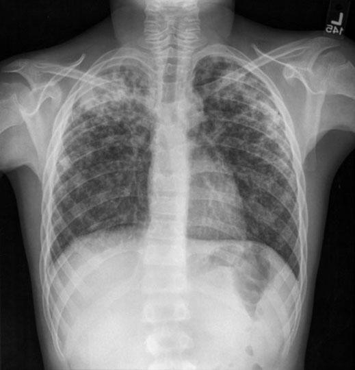 Case 2 (cont.) He is started on 4-drug therapy for tuberculosis and he responds well clinically. Sputum culture is positive for pan-susceptible M. tuberculosis, and ethambutol is stopped.
