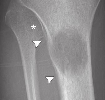 Radiograph shows round/oval lesion is geographic (type I) with narrow zone of transition (arrowheads) but no sclerotic rim (type IB).