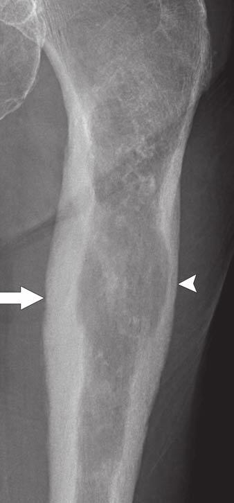 Radiography of Primary Bone Tumors Fig. 6 Low-grade chondrosarcoma of proximal femur in 84-year-old woman.
