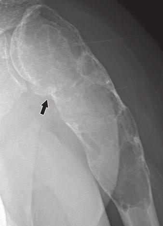 Unlike benign fibroxanthoma in Fig. 1, radiograph shows that entire circumference of this bone is enlarged by low-grade chondrosarcoma.