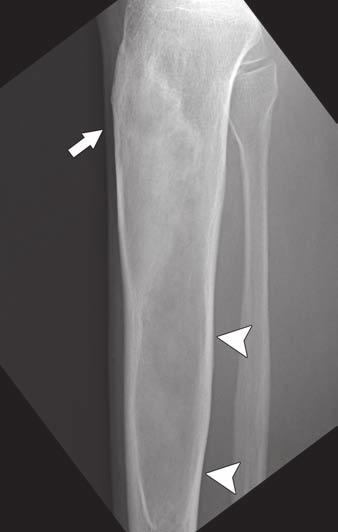 Costelloe and Madewell Fig. 9 Osteosarcoma of distal femoral metadiaphysis in 14-year-old boy. Radiograph shows multilaminar onionskin periosteal reaction anteriorly (white arrow).