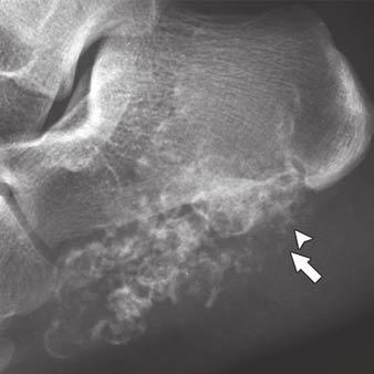 Radiograph shows proximal aspect of lesion is dedifferentiated and shows fluffy or cloudlike osteoid matrix (arrowhead) within soft-tissue mass.