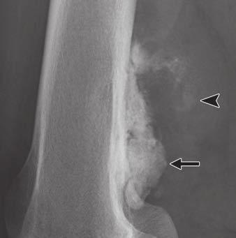 13 Fibrous cortical defect of proximal tibial metaphysis with fibrous dysplasia in distal diaphysis of 15-year-old girl.
