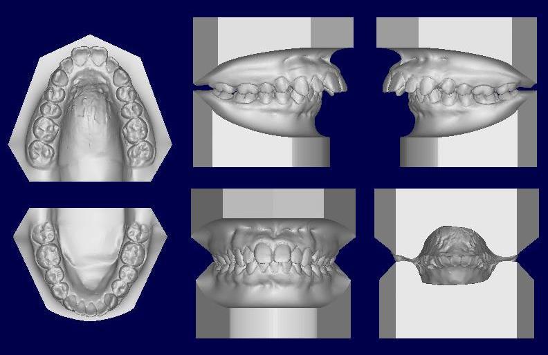 Proclined maxillary incisors Partial edentulism ½ cusp CL3 molar ½ cusp