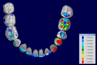 3 mm Treatment options Treatment #1: (1) Implant 46, molar uprighting (M-D), bridge