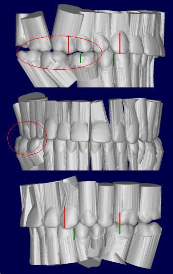 Treatment #2: Implant 46, molar uprighting (M-L, B-L), bridge 34-X-36, lower IPR 1/2 cusp Class III molars