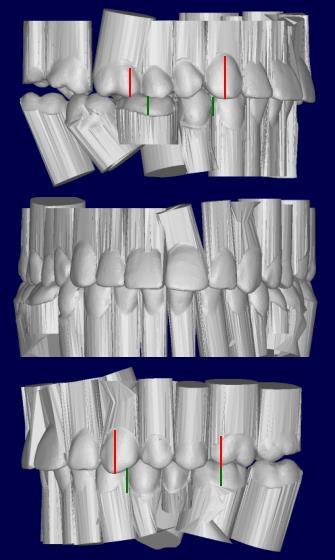 molar uprighting (M-L), bridge 34-X-36, correction of occlusal cant Class I molars 1/2 cusp Class II canines