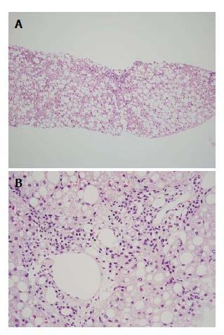 Non-alcoholic fatty liver disease Characterized by accumulation of triglycerides in hepatocytes A Steatosis - triglyceride deposition in hepatocytes (reversible) B Steatohepatitis (NASH) -