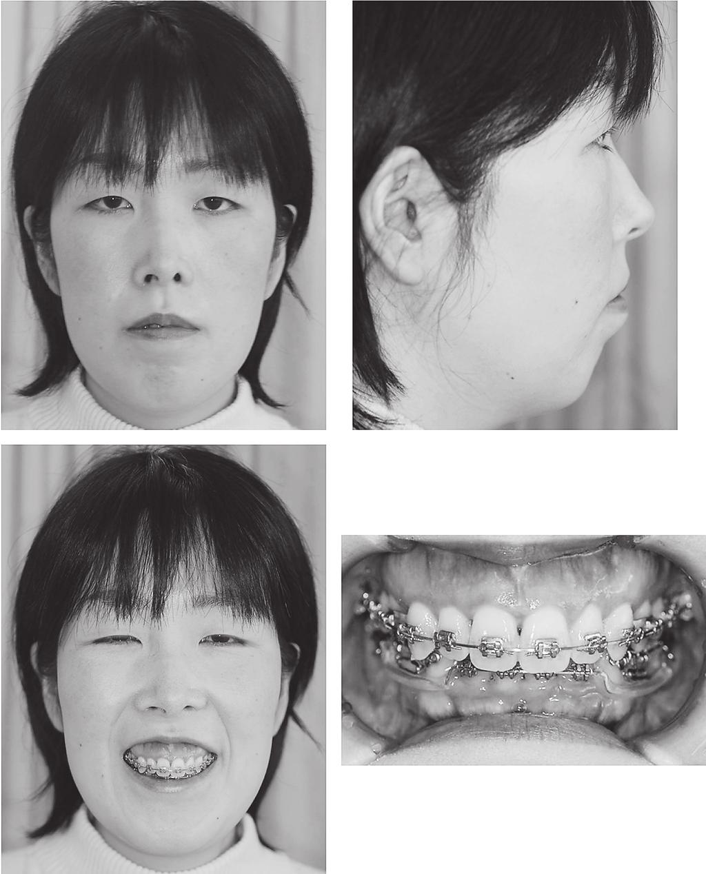 56 Shimo et l. Act Med. Okym Vol. 67, No. 1 impction cses [9, 10]. However, there re few reports out cses of severe gummy smile.