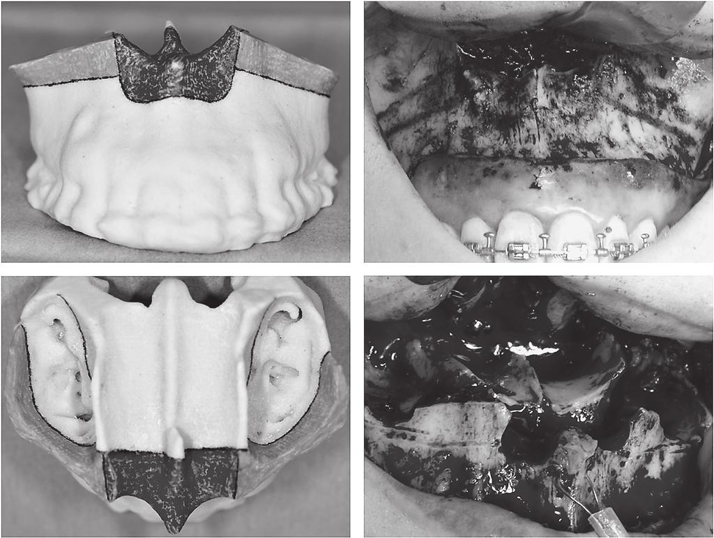 Ferury 2013 Horseshoe Osteotomy for Severe Gummy Smile ojectives were to chieve cceptle occlusion, estlish n idel overjet nd overite, nd correct the gummy smile nd retrognthic fcil ppernce.
